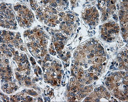 LIPG / Endothelial Lipase Antibody - IHC of paraffin-embedded Carcinoma of liver tissue using anti-LIPG mouse monoclonal antibody. (Dilution 1:50).