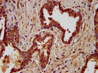 LIPH / Lipase Member H Antibody - Immunohistochemistry image at a dilution of 1:200 and staining in paraffin-embedded human prostate cancer performed on a Leica BondTM system. After dewaxing and hydration, antigen retrieval was mediated by high pressure in a citrate buffer (pH 6.0) . Section was blocked with 10% normal goat serum 30min at RT. Then primary antibody (1% BSA) was incubated at 4 °C overnight. The primary is detected by a biotinylated secondary antibody and visualized using an HRP conjugated SP system.