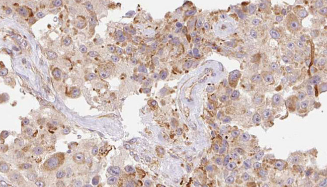 LL37 / Cathelicidin Antibody - 1:100 staining human Melanoma tissue by IHC-P. The sample was formaldehyde fixed and a heat mediated antigen retrieval step in citrate buffer was performed. The sample was then blocked and incubated with the antibody for 1.5 hours at 22°C. An HRP conjugated goat anti-rabbit antibody was used as the secondary.