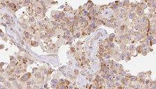 LL37 / Cathelicidin Antibody - 1:100 staining human Melanoma tissue by IHC-P. The sample was formaldehyde fixed and a heat mediated antigen retrieval step in citrate buffer was performed. The sample was then blocked and incubated with the antibody for 1.5 hours at 22°C. An HRP conjugated goat anti-rabbit antibody was used as the secondary.