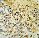 LMBR1L Antibody - LMBR1L Antibody IHC of formalin-fixed and paraffin-embedded breast carcinoma followed by peroxidase-conjugated secondary antibody and DAB staining.