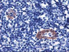 LMCD1 Antibody - IHC of paraffin-embedded Human lymphoma tissue using anti-LMCD1 mouse monoclonal antibody. (Heat-induced epitope retrieval by 10mM citric buffer, pH6.0, 100C for 10min).