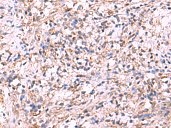 LMCD1 Antibody - Immunohistochemistry of paraffin-embedded Human cervical cancer tissue  using LMCD1 Polyclonal Antibody at dilution of 1:100(×200)