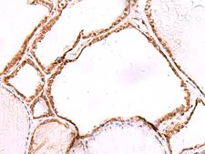 LMCD1 Antibody - Immunohistochemistry of paraffin-embedded Human thyroid cancer tissue  using LMCD1 Polyclonal Antibody at dilution of 1:80(×200)