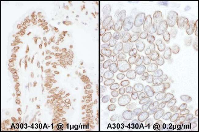 LMNA / Lamin A+C Antibody - Detection of Human Lamin-A /C by Immunohistochemistry. Samples: FFPE sections of human colon carcinoma. Antibody: Affinity purified rabbit anti-Lamin-A/C used at a dilution of 1:200 (1 ug/ml) (left) and 1:1000 (0.2 ug/ml) (right). Detection: DAB.