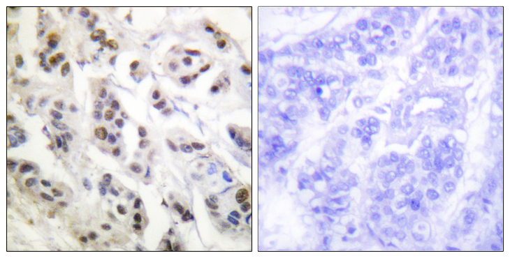 LMNA / Lamin A+C Antibody - Immunohistochemistry analysis of paraffin-embedded human breast carcinoma tissue, using Lamin A/C Antibody. The picture on the right is blocked with the synthesized peptide.