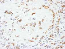 LMNA / Lamin A+C Antibody - Detection of Human Lamin-A by Immunohistochemistry. Sample: FFPE section of human testicular seminoma. Antibody: Affinity purified rabbit anti-Lamin-A used at a dilution of 1:200 (1 ug/ml). Detection: DAB.