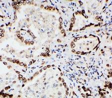LMNA / Lamin A+C Antibody - IHC-P: Lamin A/C antibody testing of human lung cancer tissue