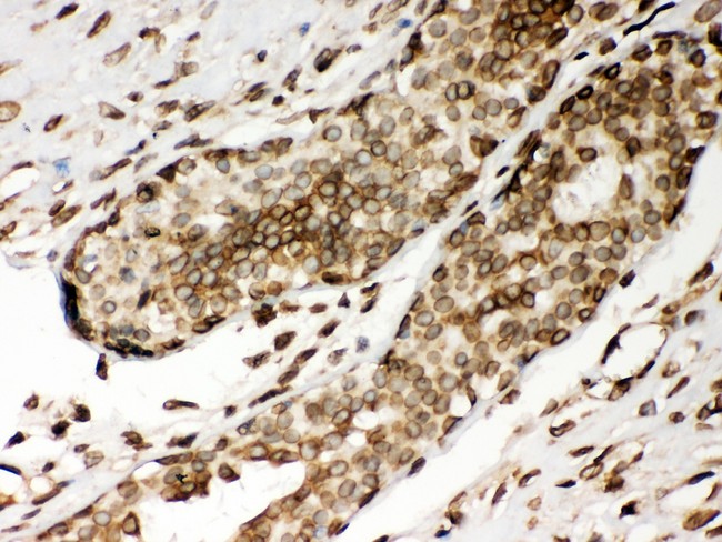 LMNA / Lamin A+C Antibody - Lamin A antibody IHC-paraffin: Human Mammary Cancer Tissue.