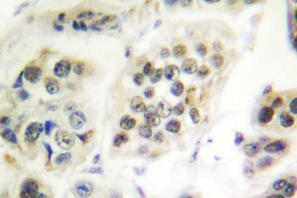 LMNA / Lamin A+C Antibody - IHC of Lamin A/C (R386) pAb in paraffin-embedded human breast carcinoma tissue.