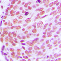 LMNA / Lamin A+C Antibody - Immunohistochemical analysis of Lamin A/C staining in human breast cancer formalin fixed paraffin embedded tissue section. The section was pre-treated using heat mediated antigen retrieval with sodium citrate buffer (pH 6.0). The section was then incubated with the antibody at room temperature and detected using an HRP conjugated compact polymer system. DAB was used as the chromogen. The section was then counterstained with hematoxylin and mounted with DPX.