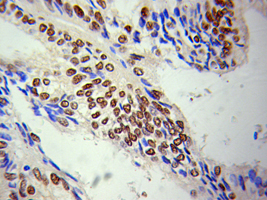 LMNA / Lamin A+C Antibody - Immunohistochemistry of paraffin-embedded human breast tumor, showing staining of the nuclear envelope.
