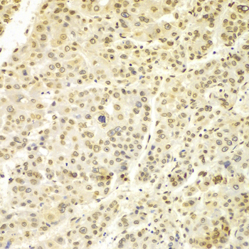 LMNA / Lamin A+C Antibody - Immunohistochemistry of paraffin-embedded human liver cancer using Lamin A/C antibodyat dilution of 1:100 (40x lens).