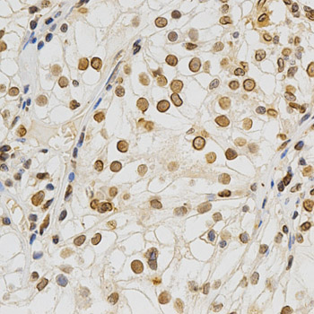 LMNA / Lamin A+C Antibody - Immunohistochemistry of paraffin-embedded human kidney cancer using Lamin A/C antibodyat dilution of 1:200 (40x lens).