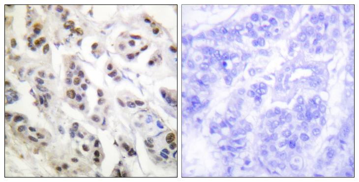 LMNA / Lamin A+C Antibody - Peptide - + Immunohistochemistry analysis of paraffin-embedded human breast carcinoma tissue using Lamin A/B (Ab-392) antibody.