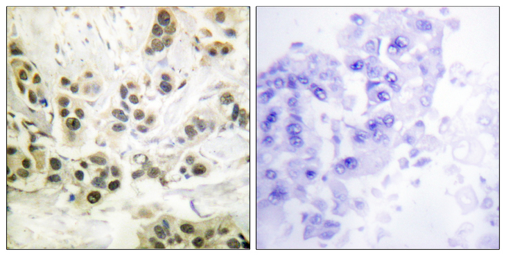 LMNA / Lamin A+C Antibody - Immunohistochemistry analysis of paraffin-embedded human breast carcinoma, using Lamin A/C (Phospho-Ser392) Antibody. The picture on the right is blocked with the phospho peptide.