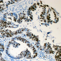 LMNA / Lamin A+C Antibody - Immunohistochemical analysis of Lamin A/C (pS392) staining in human colon cancer formalin fixed paraffin embedded tissue section. The section was pre-treated using heat mediated antigen retrieval with sodium citrate buffer (pH 6.0). The section was then incubated with the antibody at room temperature and detected using an HRP conjugated compact polymer system. DAB was used as the chromogen. The section was then counterstained with hematoxylin and mounted with DPX.