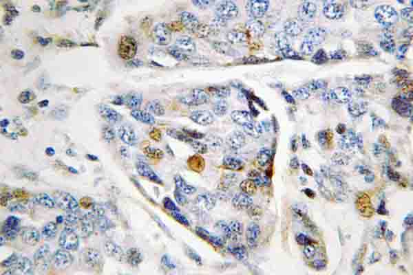 LMNA / Lamin A+C Antibody - IHC of Lamin A (S17) pAb in paraffin-embedded human breast carcinoma tissue.