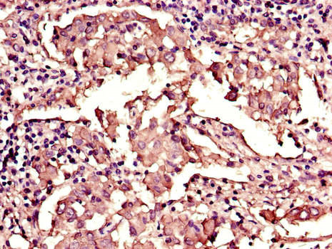 LMNB1 / Lamin B1 Antibody - Immunohistochemistry of paraffin-embedded human lung cancer using LMNB1 Antibody at dilution of 1:100