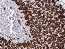LMNB1 / Lamin B1 Antibody - 1/100 staining human Pancreas cancer tissue by IHC-P. The sample was formaldehyde fixed and a heat mediated antigen retrieval step in citrate buffer was performed. The sample was then blocked and incubated with the antibody for 1.5 hours at 22°C. An HRP conjugated goat anti-rabbit antibody was used as the secondary antibody.