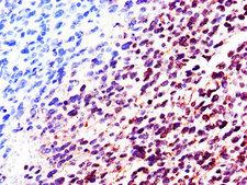 LMNB2 / Lamin B2 Antibody - Immunohistochemistry of paraffin-embedded human glioma cancer using LMNB2 Antibody at dilution of 1:100