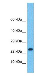 LMO2 Antibody - LMO2 antibody Western Blot of Ovary Tumor. Antibody dilution: 1 ug/ml.  This image was taken for the unconjugated form of this product. Other forms have not been tested.
