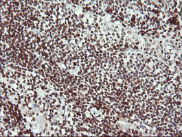 LMO2 Antibody - IHC of paraffin-embedded Human lymphoma tissue using anti-LMO2 mouse monoclonal antibody. (Heat-induced epitope retrieval by 10mM citric buffer, pH6.0, 120°C for 3min).