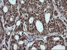 LMO2 Antibody - IHC of paraffin-embedded Adenocarcinoma of Human breast tissue using anti-LMO2 mouse monoclonal antibody.