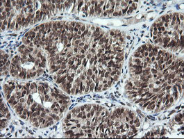 LMO2 Antibody - IHC of paraffin-embedded Adenocarcinoma of Human ovary tissue using anti-LMO2 mouse monoclonal antibody.