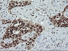 LMO2 Antibody - IHC of paraffin-embedded Carcinoma of Human bladder tissue using anti-LMO2 mouse monoclonal antibody.