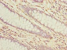 LMO4 Antibody - Immunohistochemistry of paraffin-embedded human colon cancer at dilution 1:100