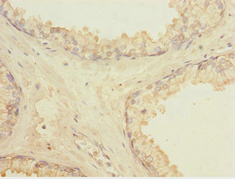 LMO4 Antibody - Immunohistochemistry of paraffin-embedded human prostate cancer at dilution 1:100