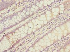LMO4 Antibody - Immunohistochemistry of paraffin-embedded human colon cancer at dilution 1:100