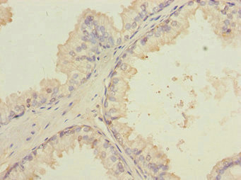 LMO4 Antibody - Immunohistochemistry of paraffin-embedded human prostate cancer at dilution 1:100