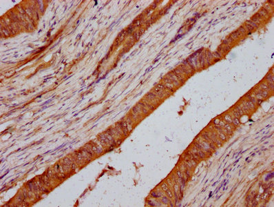 LMO7 Antibody - Immunohistochemistry Dilution at 1:200 and staining in paraffin-embedded human colon cancer performed on a Leica BondTM system. After dewaxing and hydration, antigen retrieval was mediated by high pressure in a citrate buffer (pH 6.0). Section was blocked with 10% normal Goat serum 30min at RT. Then primary antibody (1% BSA) was incubated at 4°C overnight. The primary is detected by a biotinylated Secondary antibody and visualized using an HRP conjugated SP system.