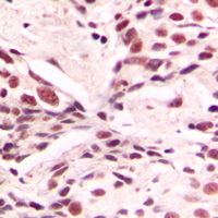 LMX1B Antibody - Immunohistochemical analysis of LMX1B staining in human breast cancer formalin fixed paraffin embedded tissue section. The section was pre-treated using heat mediated antigen retrieval with sodium citrate buffer (pH 6.0). The section was then incubated with the antibody at room temperature and detected using an HRP conjugated compact polymer system. DAB was used as the chromogen. The section was then counterstained with hematoxylin and mounted with DPX.