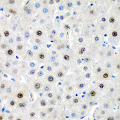 LMX1B Antibody - Immunohistochemistry of paraffin-embedded human liver cancer tissue.