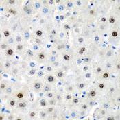 LMX1B Antibody - Immunohistochemistry of paraffin-embedded Human liver cancer using LMX1B Polyclonal Antibody at dilution of 1:200 (40x lens).