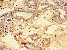 LOC100131801 Antibody - Immunohistochemistry of paraffin-embedded human breast cancer using PET100 Antibody at dilution of 1:100