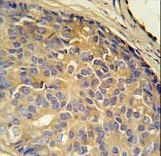 LOH12CR1 Antibody - LOH12CR1 Antibody immunohistochemistry of formalin-fixed and paraffin-embedded human prostate carcinoma followed by peroxidase-conjugated secondary antibody and DAB staining.