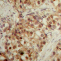 LONP2 / LONP Antibody - Immunohistochemical analysis of LONP2 staining in human breast cancer formalin fixed paraffin embedded tissue section. The section was pre-treated using heat mediated antigen retrieval with sodium citrate buffer (pH 6.0). The section was then incubated with the antibody at room temperature and detected with HRP and DAB as chromogen. The section was then counterstained with hematoxylin and mounted with DPX.