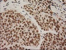LOX / Lysyl Oxidase Antibody - IHC of paraffin-embedded Adenocarcinoma of Human breast tissue using anti-LOX mouse monoclonal antibody.
