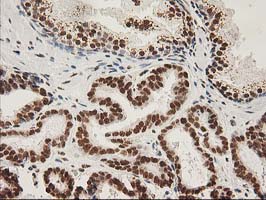 LOX / Lysyl Oxidase Antibody - IHC of paraffin-embedded Carcinoma of Human prostate tissue using anti-LOX mouse monoclonal antibody.