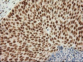 LOX / Lysyl Oxidase Antibody - IHC of paraffin-embedded Carcinoma of Human bladder tissue using anti-LOX mouse monoclonal antibody.
