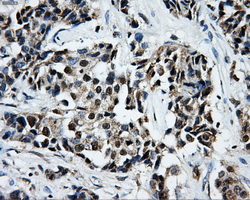 LOX / Lysyl Oxidase Antibody - Immunohistochemical staining of paraffin-embedded Adenocarcinoma of breast tissue using anti-LOX mouse monoclonal antibody. (Dilution 1:50).