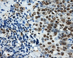 LOX / Lysyl Oxidase Antibody - Immunohistochemical staining of paraffin-embedded Adenocarcinoma of ovary tissue using anti-LOX mouse monoclonal antibody. (Dilution 1:50).