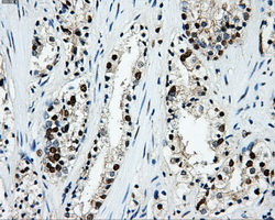 LOX / Lysyl Oxidase Antibody - Immunohistochemical staining of paraffin-embedded Carcinoma of prostate tissue using anti-LOX mouse monoclonal antibody. (Dilution 1:50).