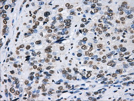 LOX / Lysyl Oxidase Antibody - IHC of paraffin-embedded Carcinoma of bladder tissue using anti-LOX mouse monoclonal antibody. (Dilution 1:50).
