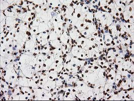 LOX / Lysyl Oxidase Antibody - IHC of paraffin-embedded Carcinoma of Human kidney tissue using anti-LOX mouse monoclonal antibody.