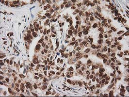 LOX / Lysyl Oxidase Antibody - IHC of paraffin-embedded Carcinoma of Human lung tissue using anti-LOX mouse monoclonal antibody.
